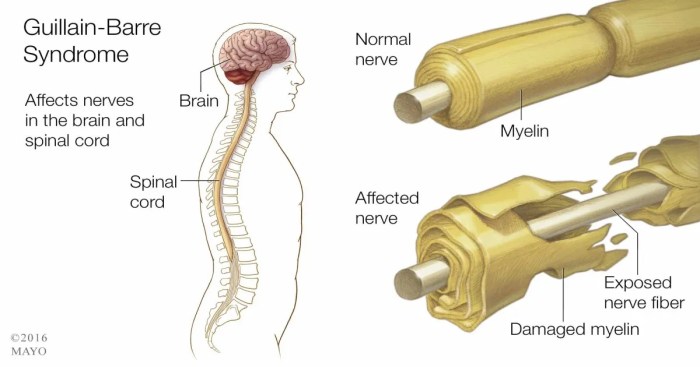 Guillain barré syndrome hesi case study